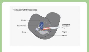 Follicular Study Scan: A Complete Useful Guide