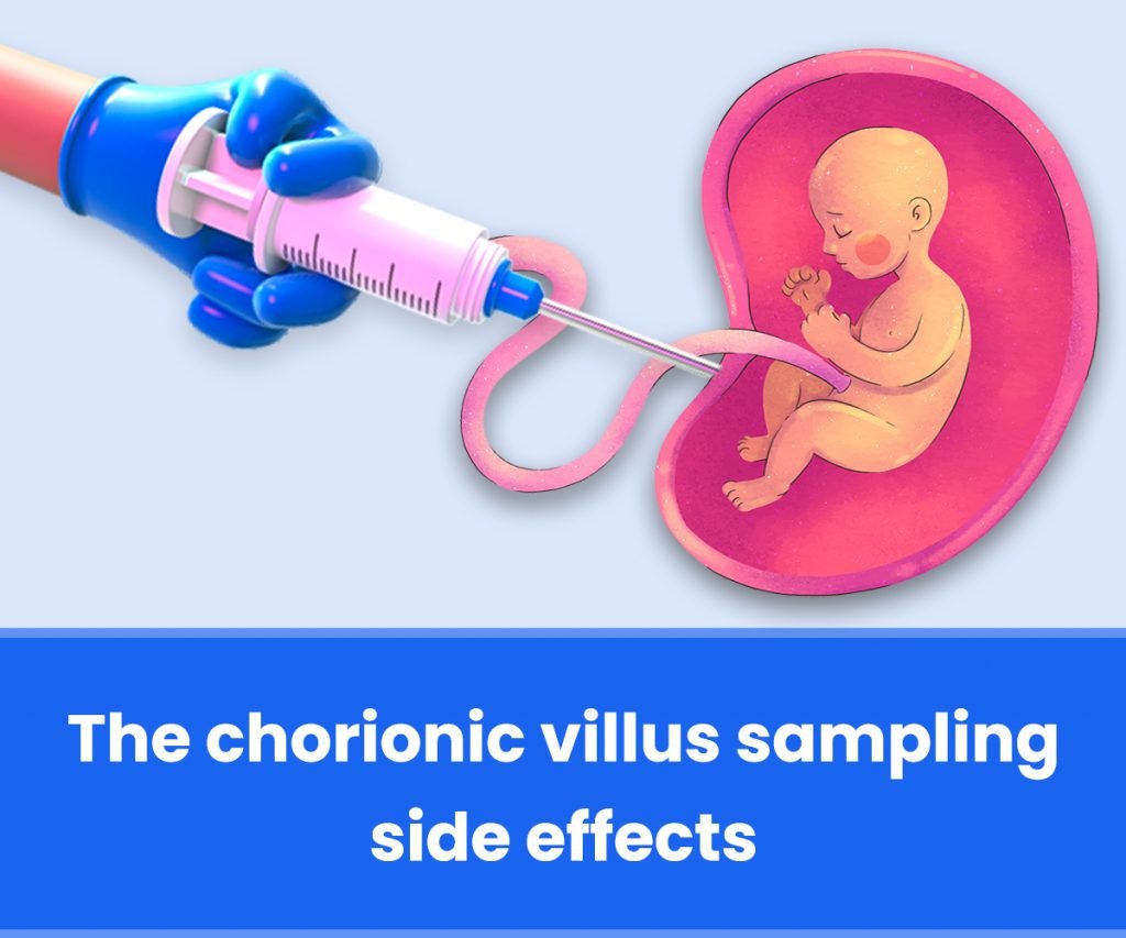 Chorionic villus sampling side effects