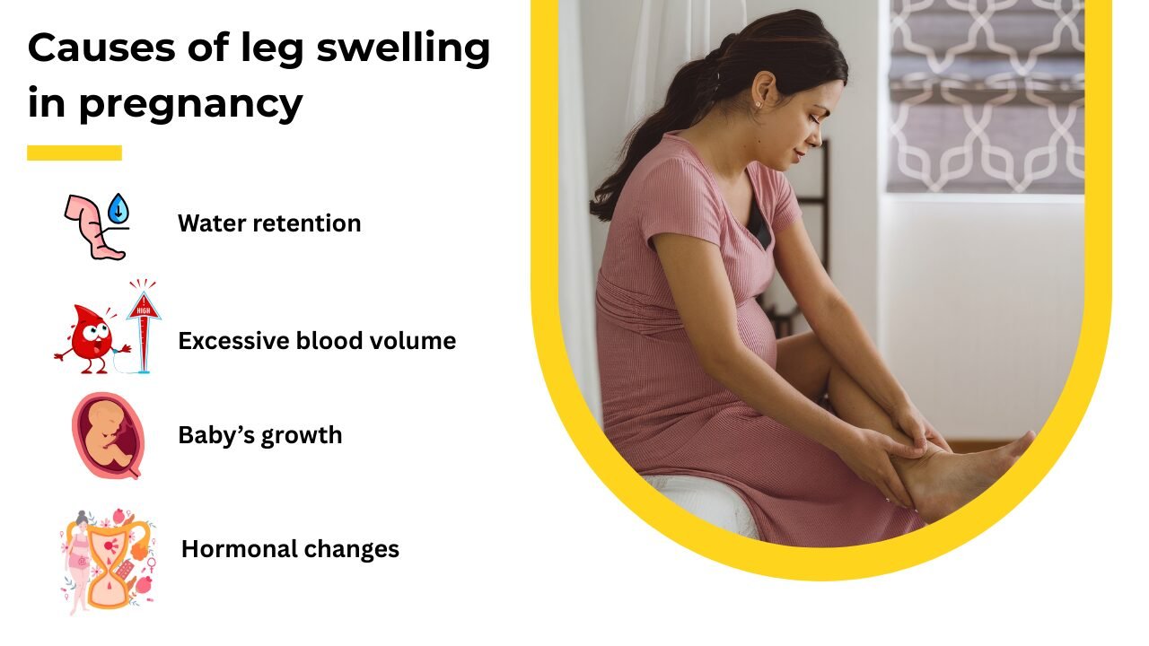 Causes of leg swelling in pregnancy