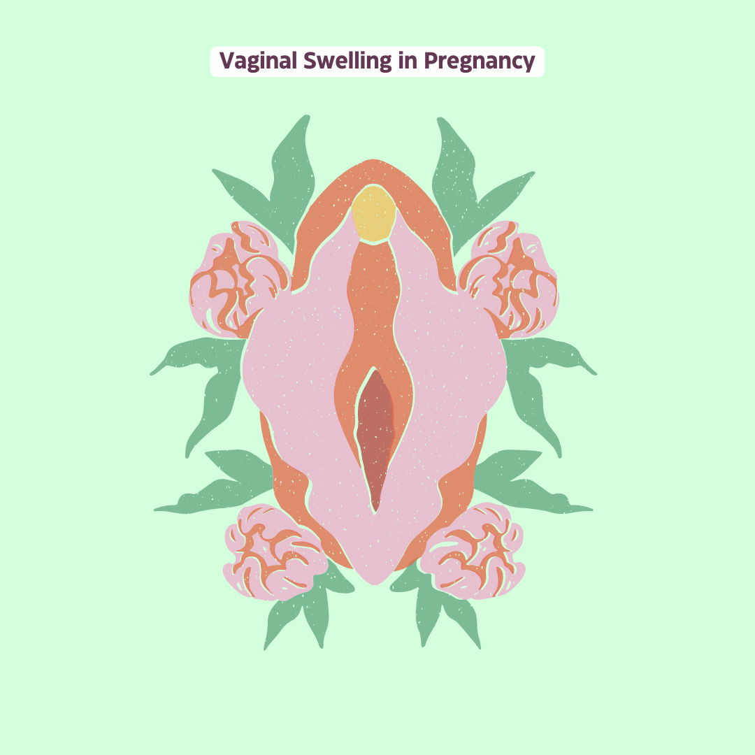 Vaginal Swelling in Pregnancy