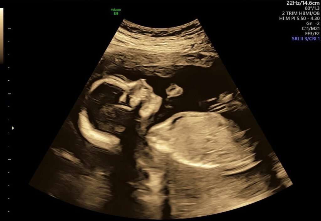 Anomaly Scan - Baby face