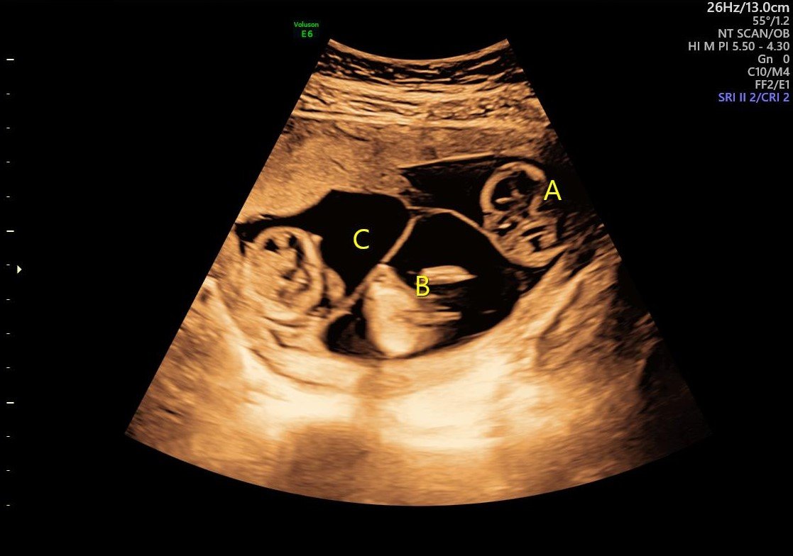 Multiple Pregnancies