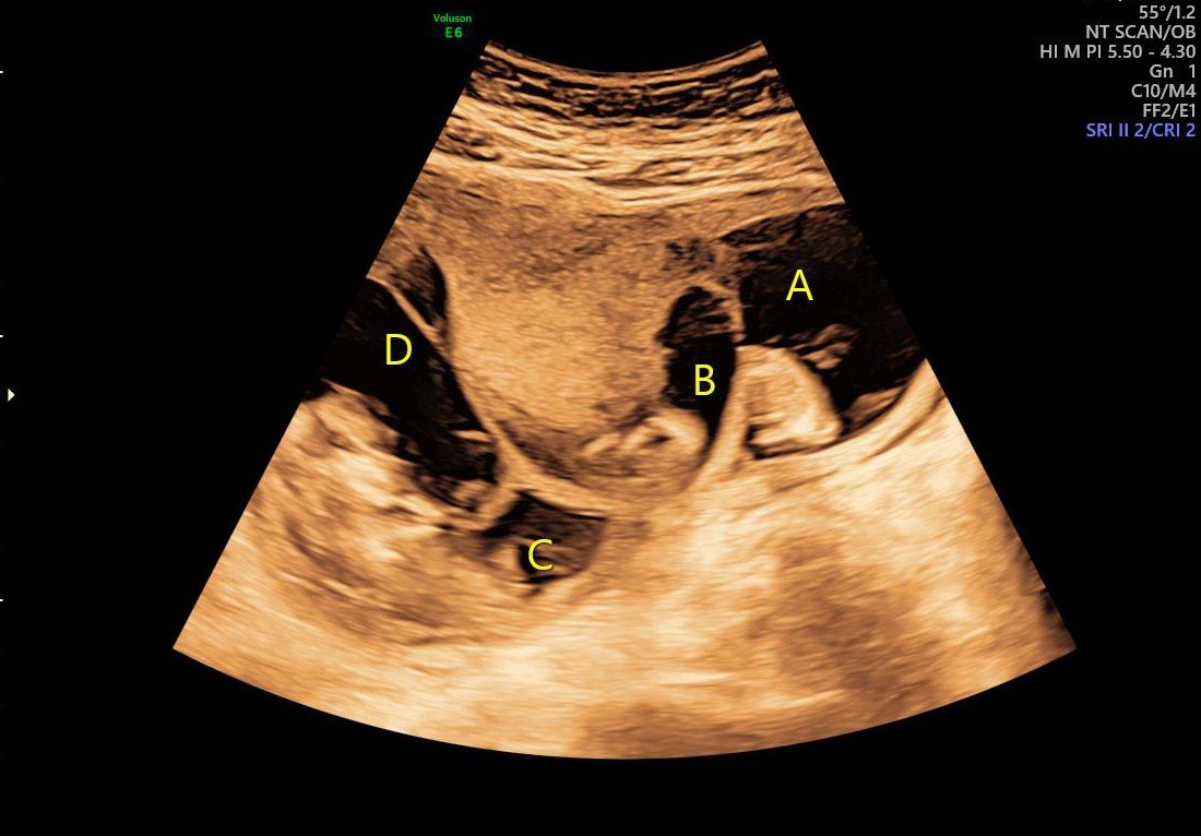 Multiple Pregnancies 4 Fetus