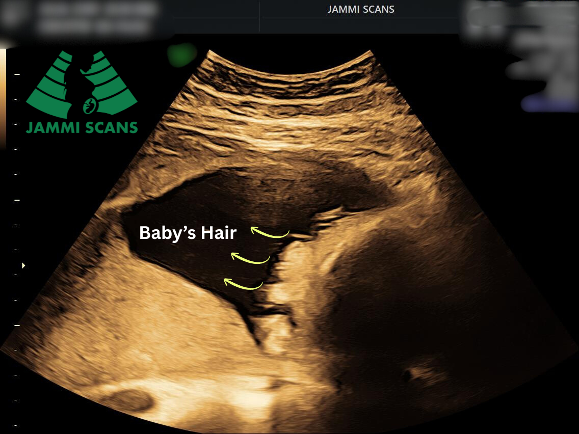 Baby’s Hair on a pregnancy scan