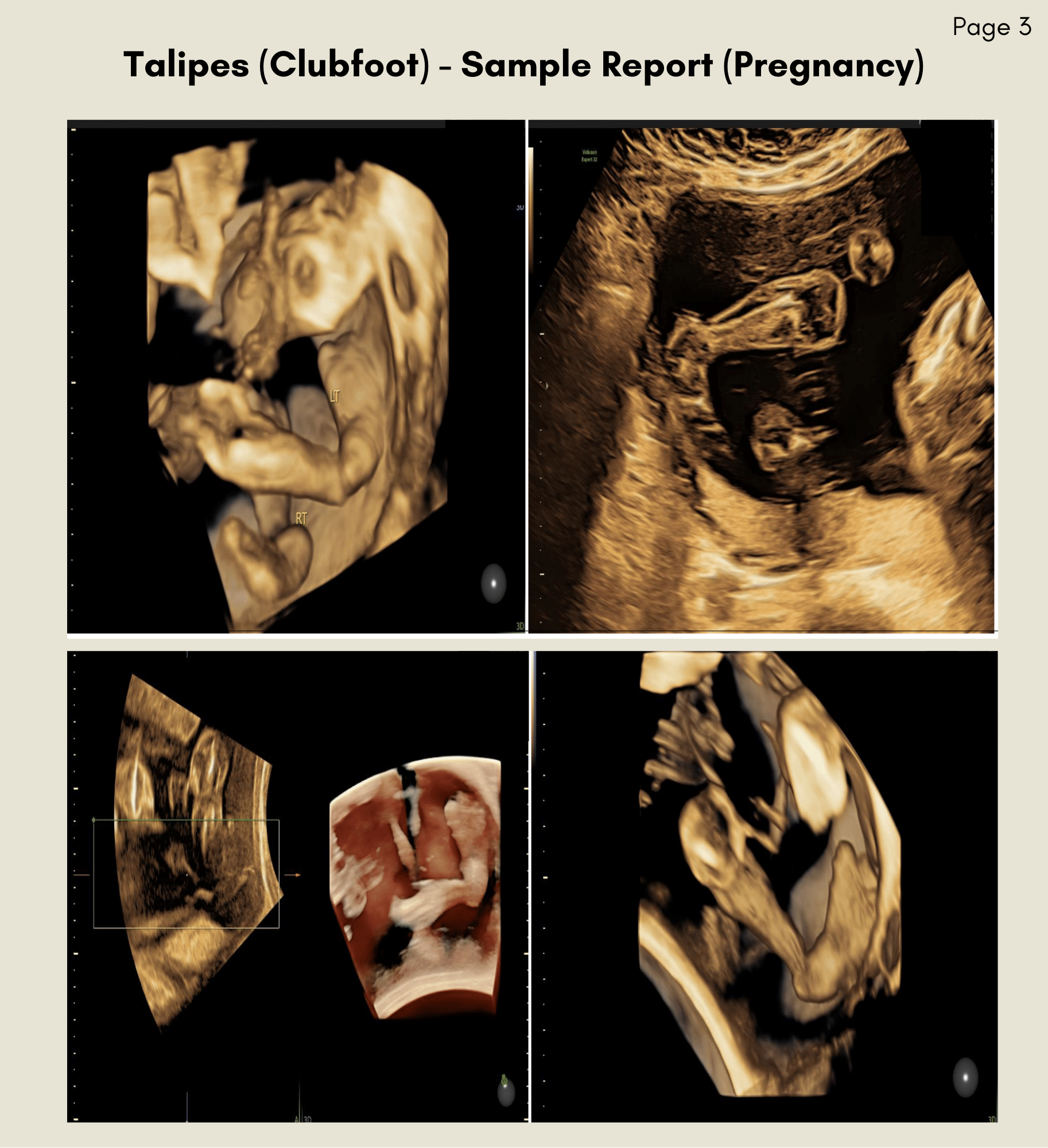 Talipes (clubfoot) Patient Report png