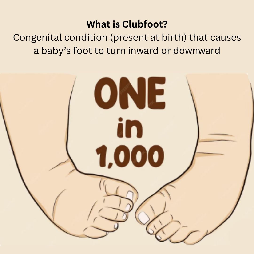 What is Clubfoot