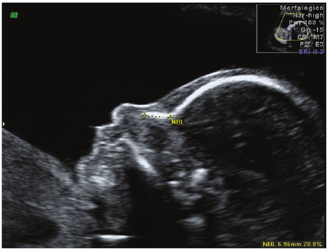 Ultrasound Abnormalities in the head/skull