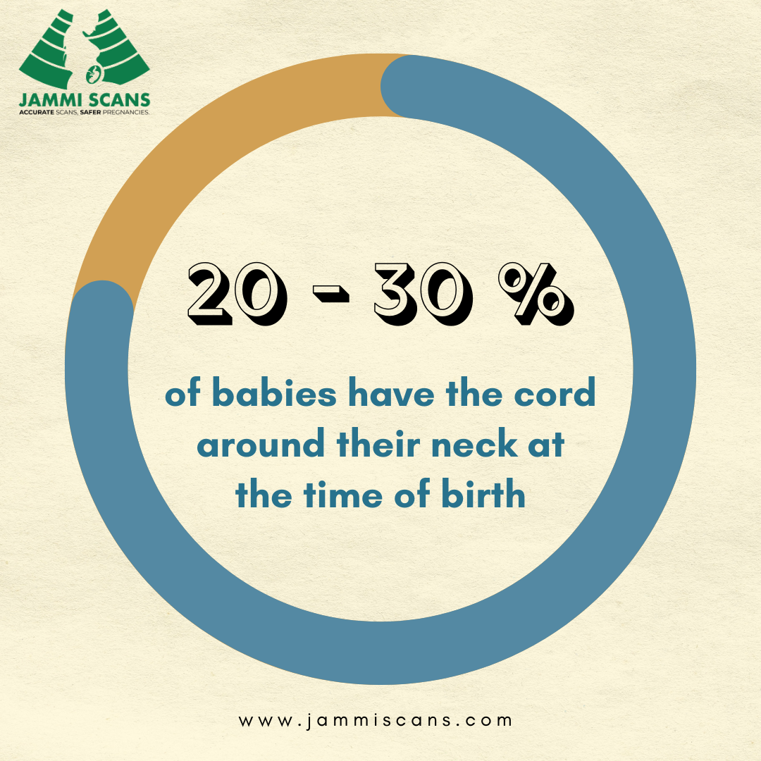 20 30 % of babies have the cord around their neck at the time of birth