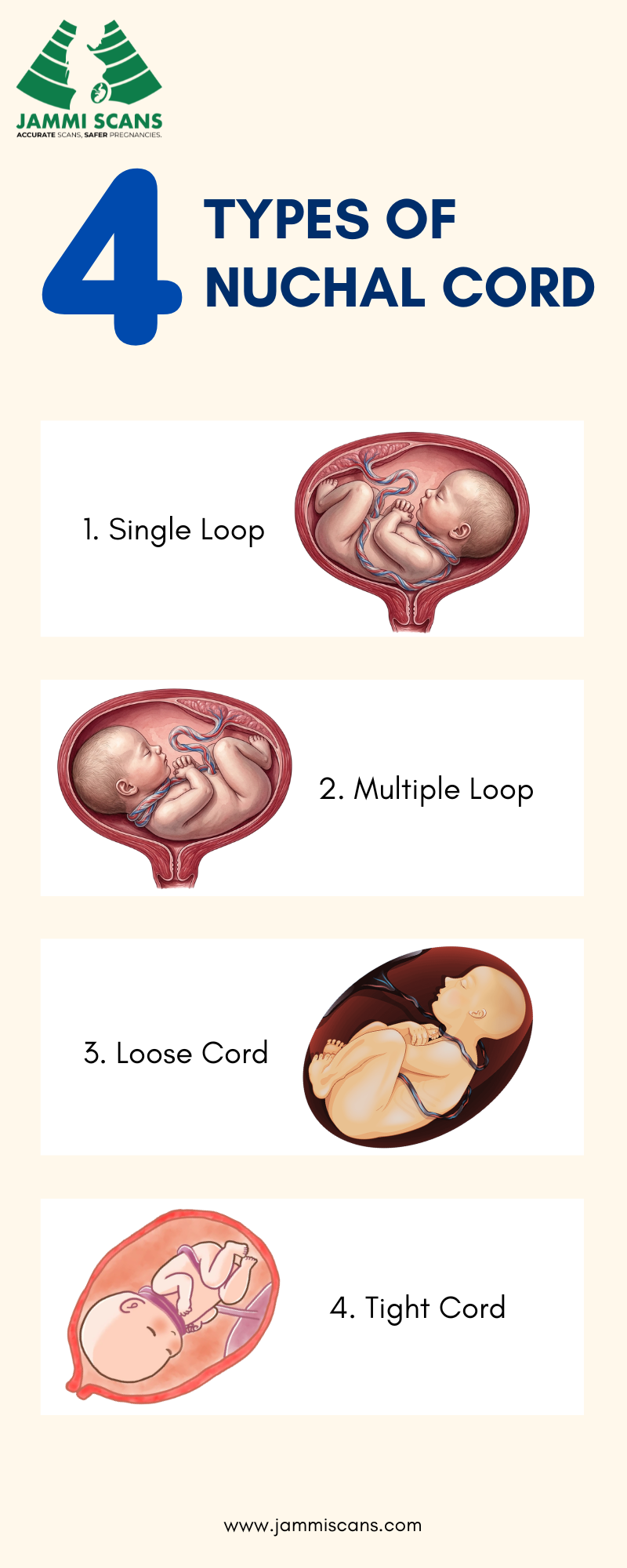4 Types of Nuchal Cord (1)