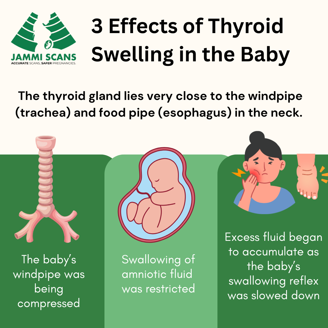 3 Effects of Thyroid Swelling in the Baby