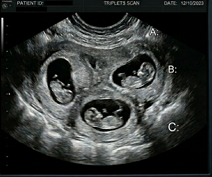 Ultrasound Scan Illustration