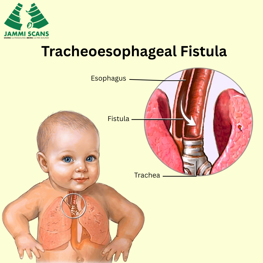 Tracheoesophageal Fistula