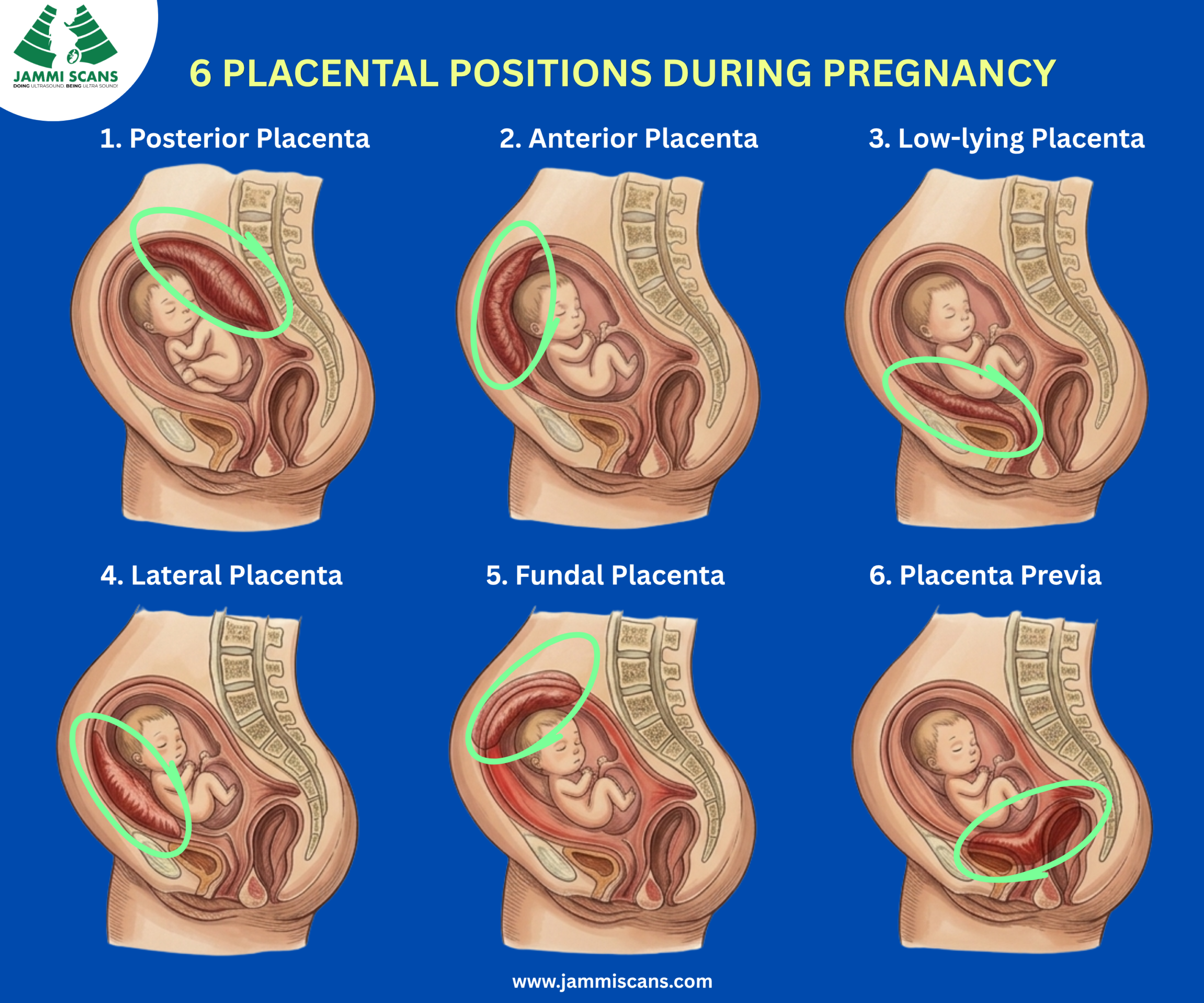 6 common placental positions during pregnancy 6 common placental positions during pregnancy