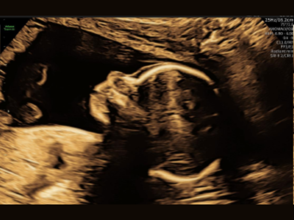 Ultrasound of Fetus (1)