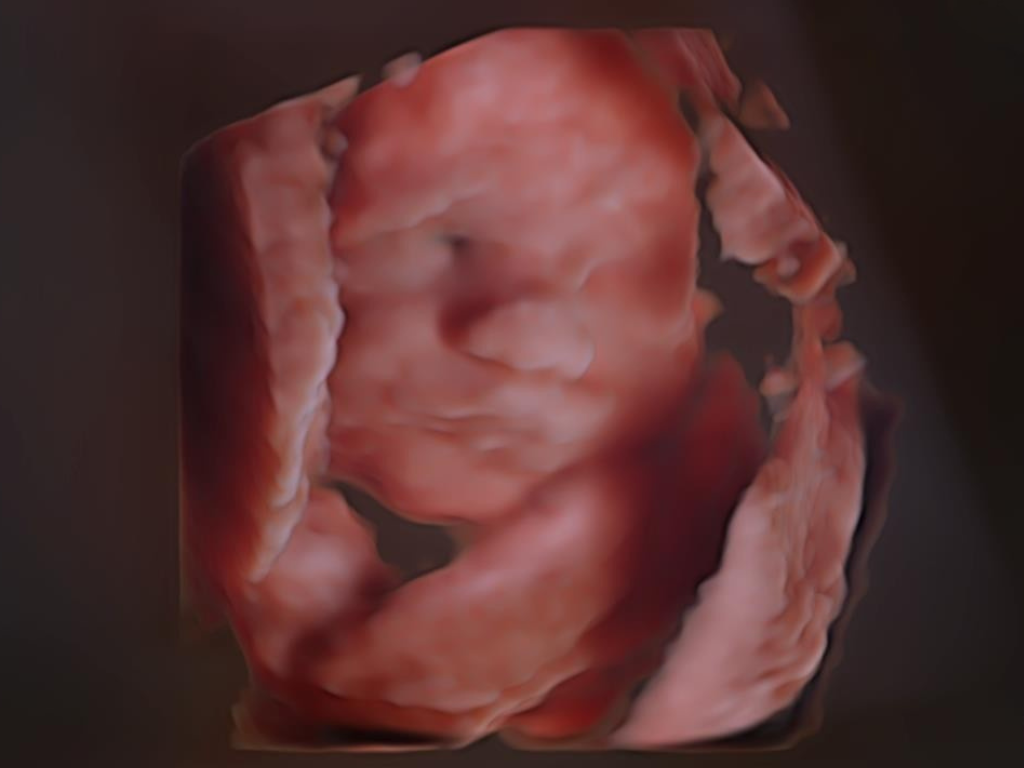 3D image of the Fetus - Voluson Expert 22