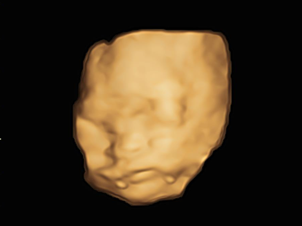 3D image of the fetus - Normal Ultrasound Machine