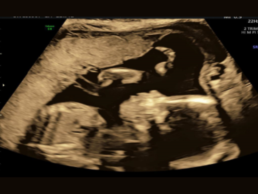 Ultrasound of Fetus